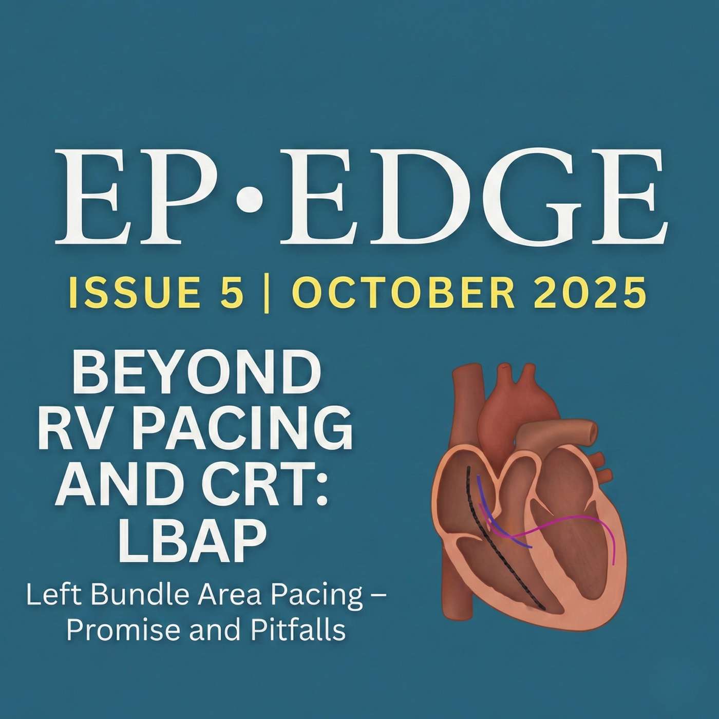 Beyond CRT: LBBAP and the New Era of Physiological Pacing — Promise and Pitfalls: EP Edge Newsletter October 2025 Issue 5