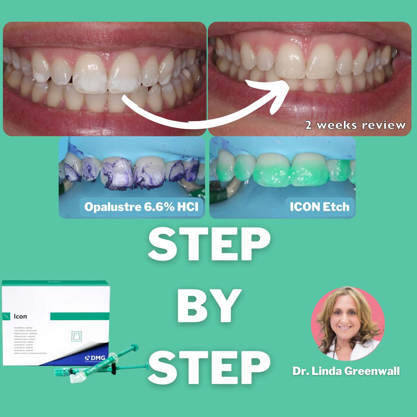 ICON Resin Infiltration – Step by Step FULL PROTOCOL – PDP140 episode artwork