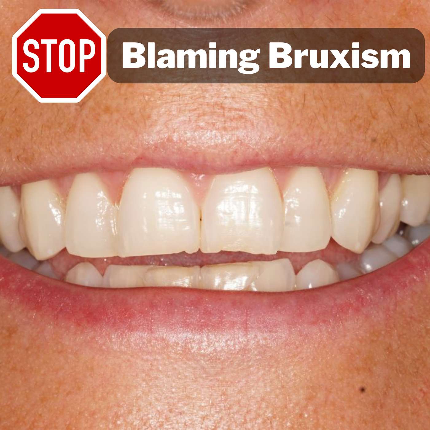Stop Blaming Bruxism! How to Spot Frictional and Constricted Chewing Patterns (CCP) – PDP141 episode artwork