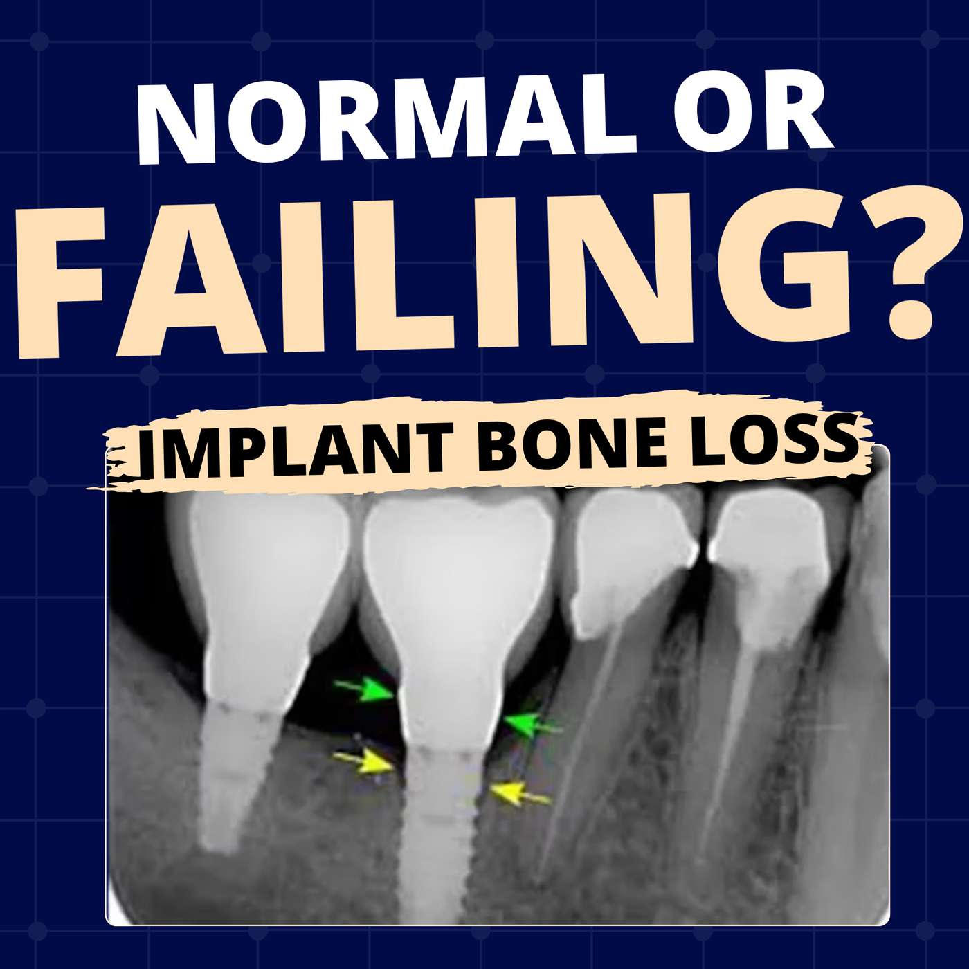 What Should You Do? Bone Loss Around Implants and Screw Loosening – GF014 episode artwork