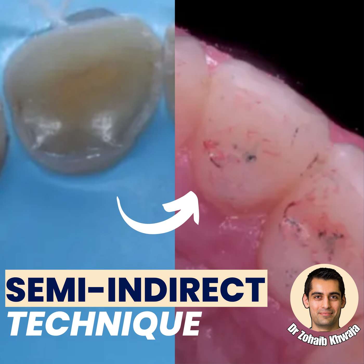 The Semi-Indirect Technique for Toothwear Cases – PDP187 episode artwork