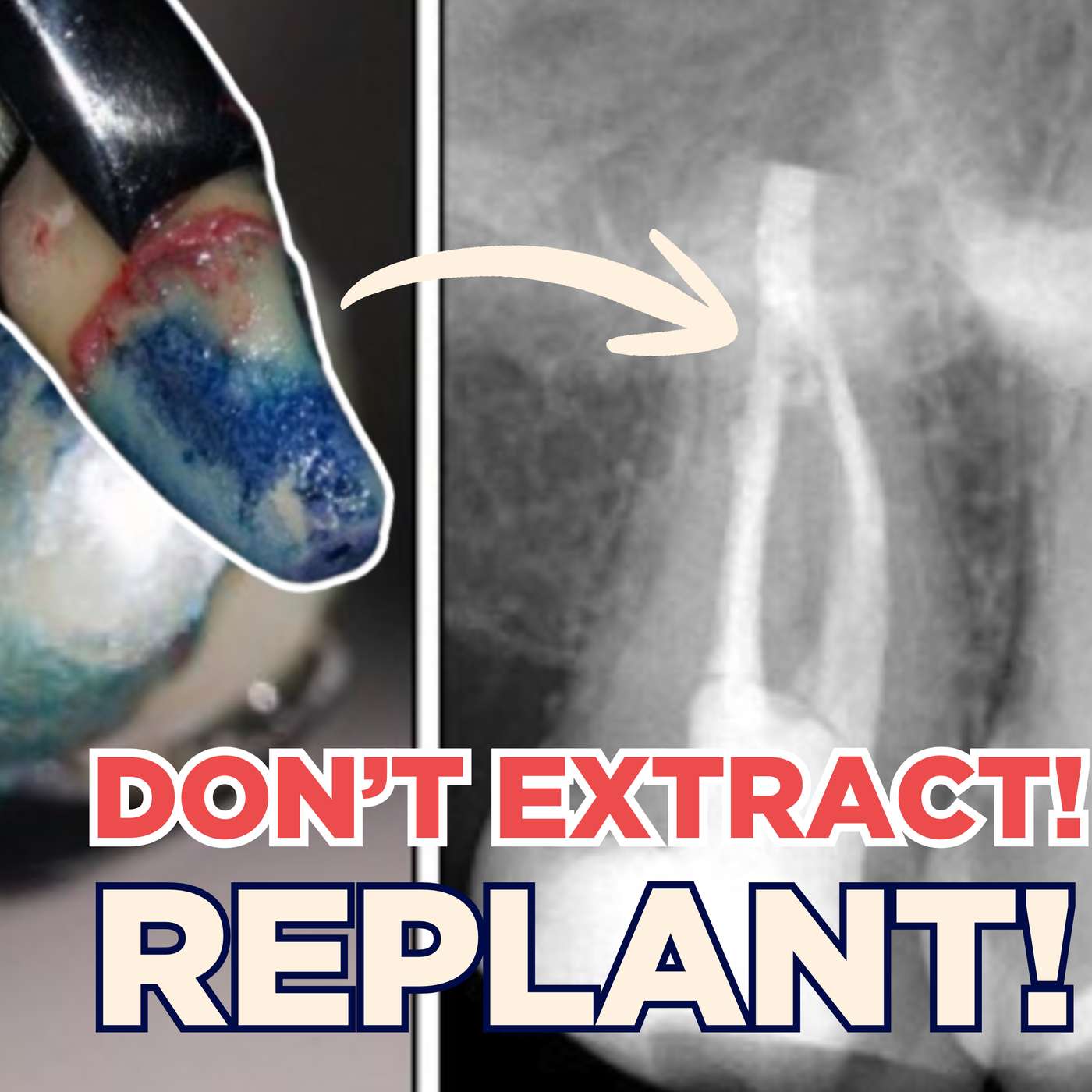 Before You Extract: Intentional Replantation in Practice – PDP256