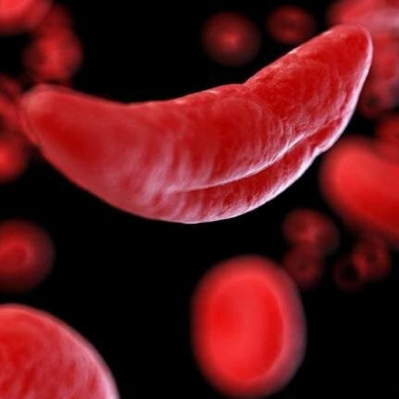 Raising Awareness on Sickle Cell Disease (20.06.21)