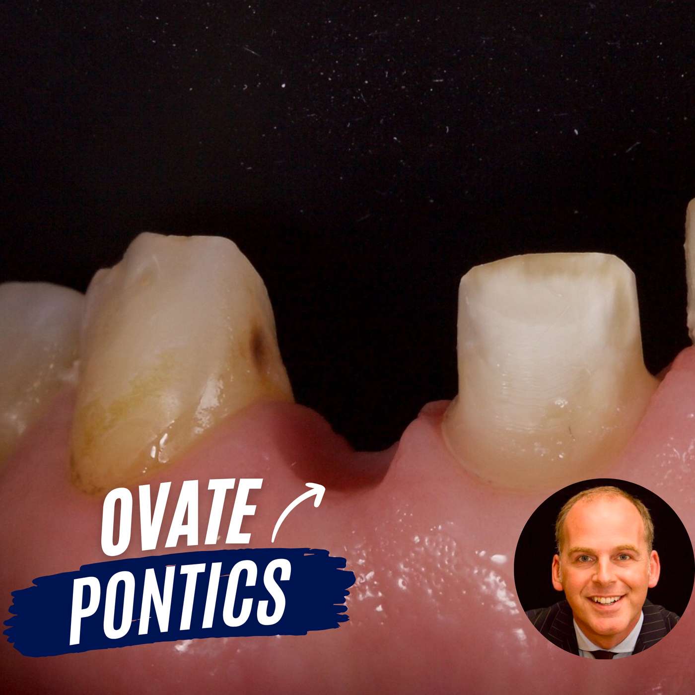 Ovate Pontics for Bridges – The Complete Guide with Dr Jason Smithson – PDP158 episode artwork