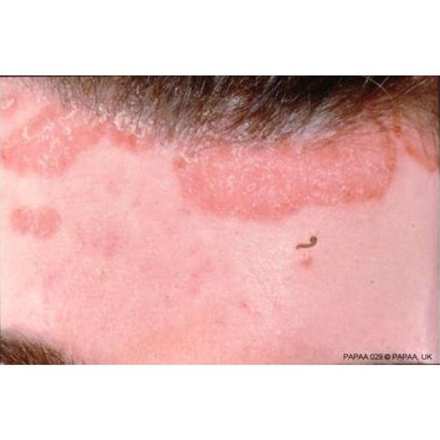 LifeWave Patching for Your Summer Skin:  Bug Bites, Rashes, Wrinkles & Sunburns episode artwork