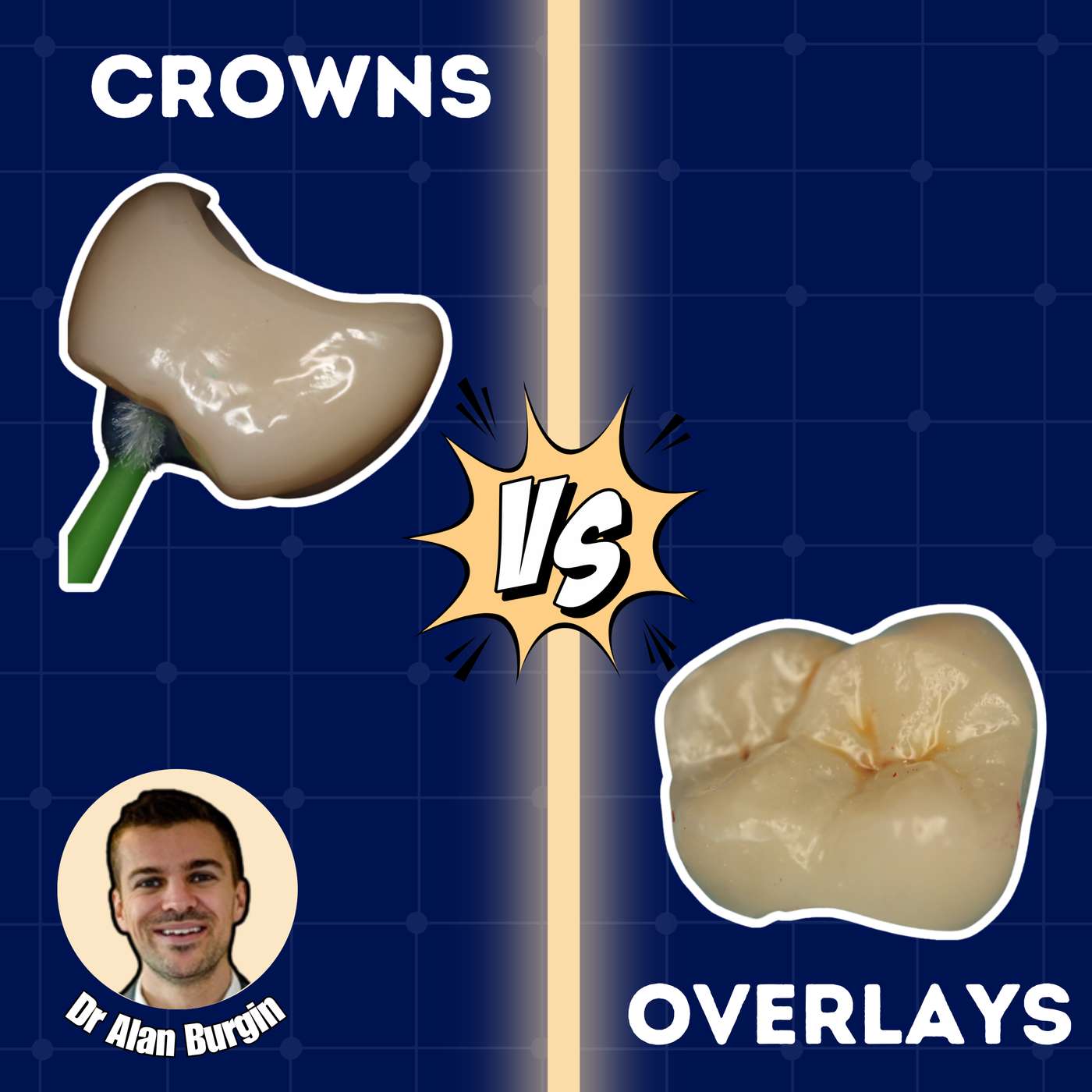 Onlays Vs Full Crowns – Decision Making 2024 – PDP189 episode artwork