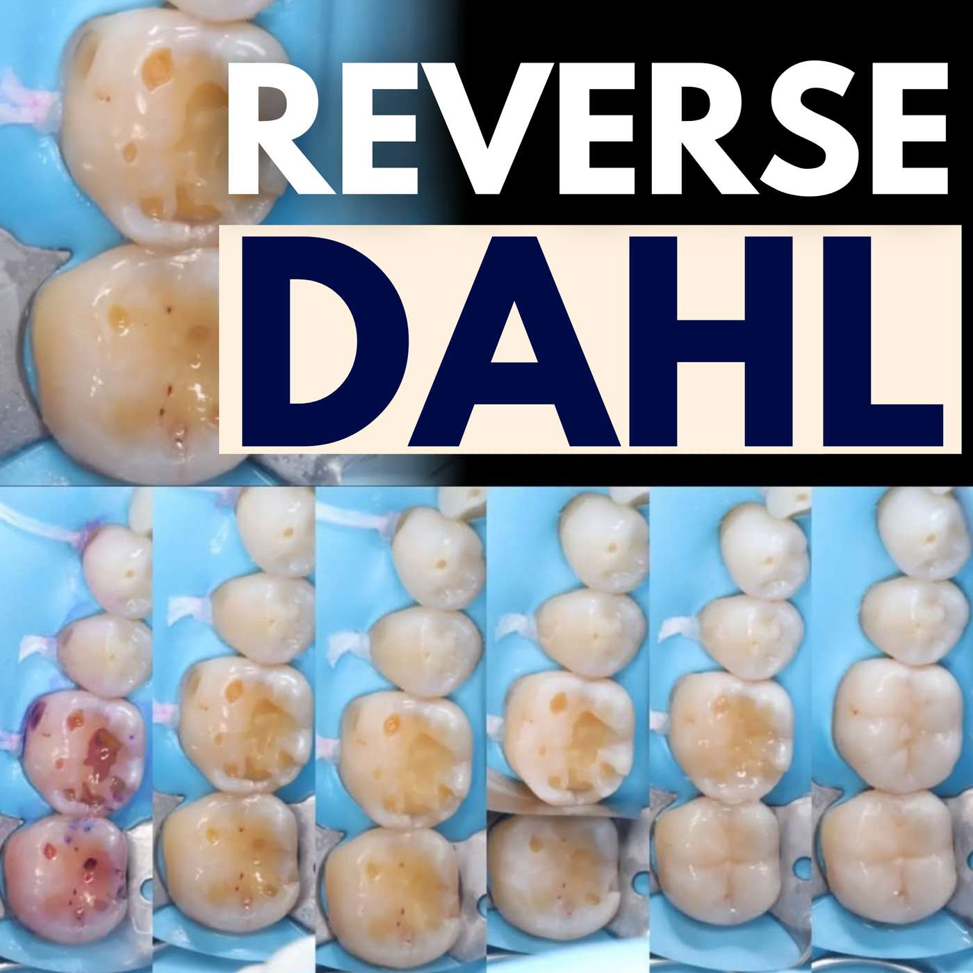 Reverse Dahl Technique for Localised Posterior Tooth Surface Loss – PDP235