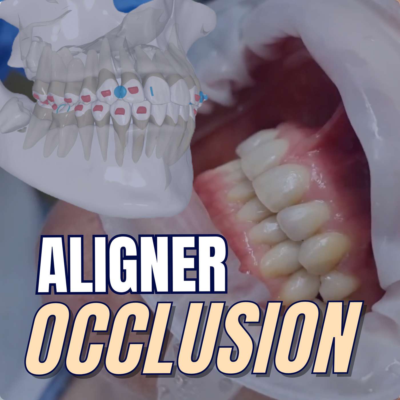 Occlusion for Aligners – Clinical Guidelines for GDPs – PDP250