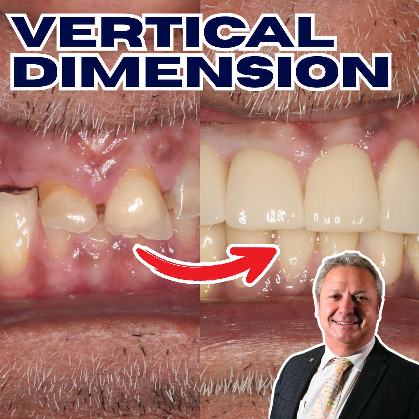 Steps for Increasing the Vertical Dimension of Occlusion with David Bloom – PDP232