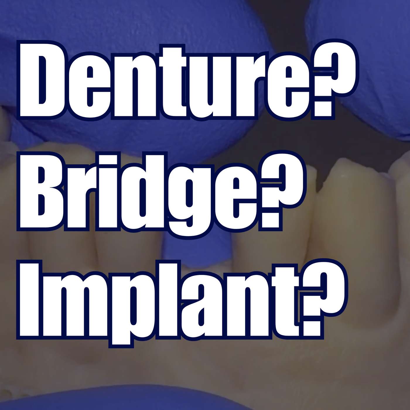 Replacement Options for Incisors – Denture? Bridge? Implant? – PS018