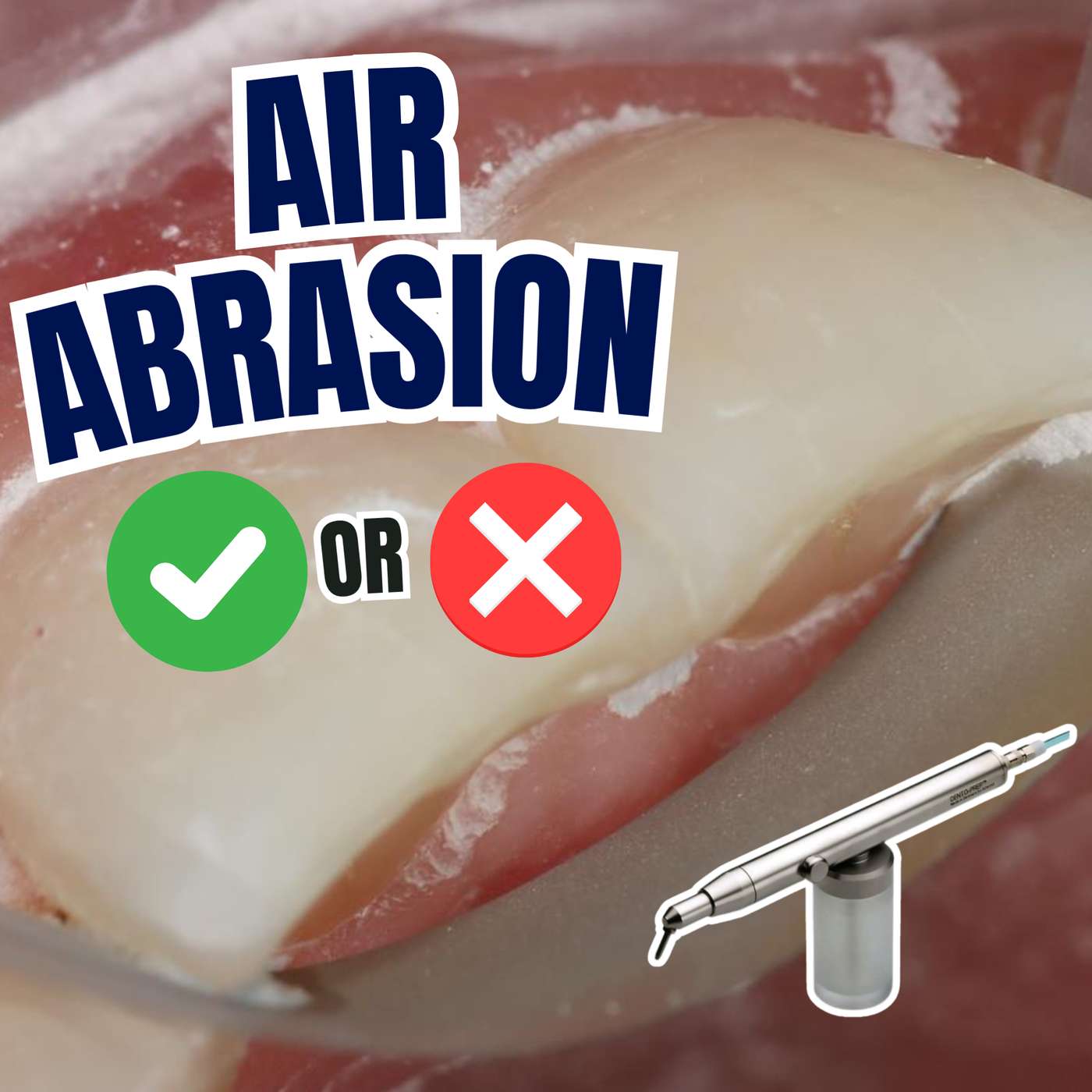Does Air Particle Abrasion ACTUALLY Improve Clinical Outcomes? – PDP190 episode artwork