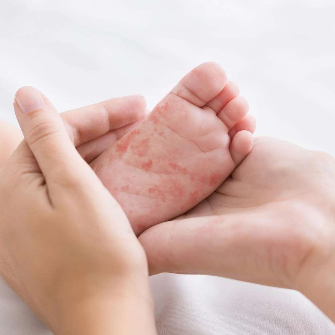 S’inquiéter de la rougeole S’inquiéter de la rougeole