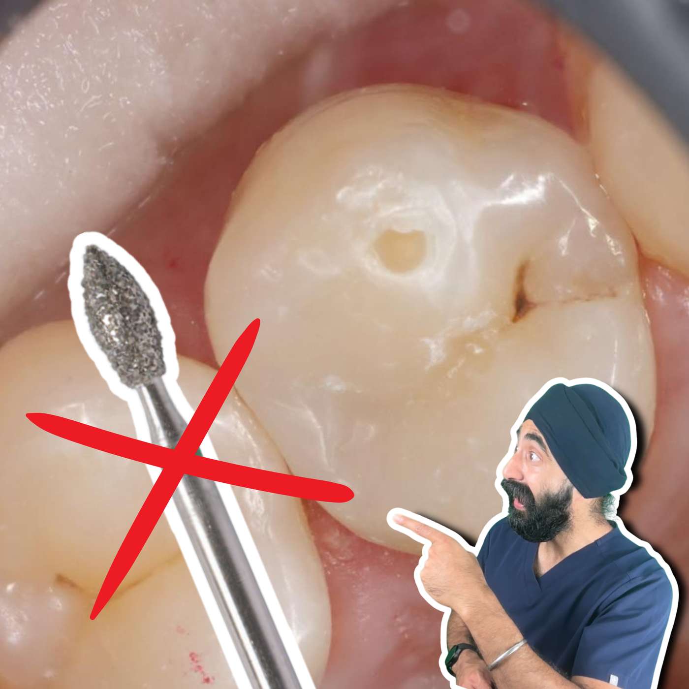 How to Place Posterior Composites without Destroying Your Anatomy – PDP200 episode artwork