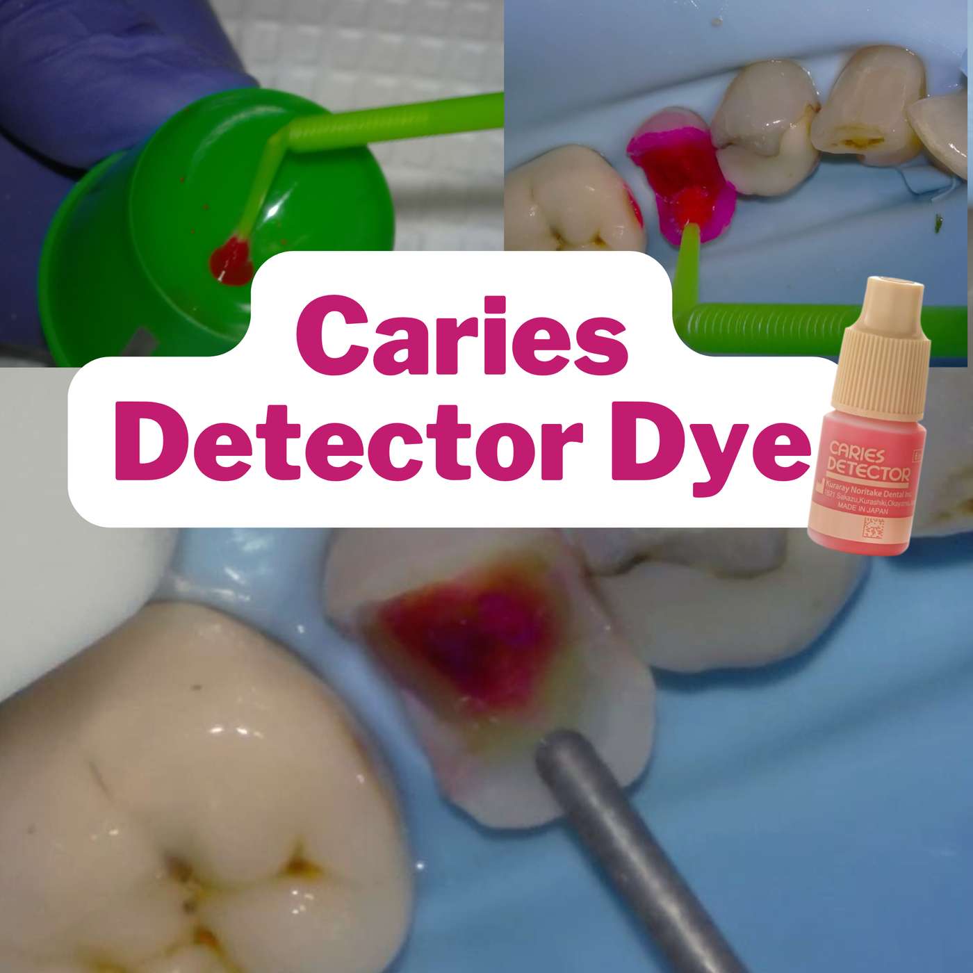 Is Caries Detector Dye BS? – PDP138 episode artwork