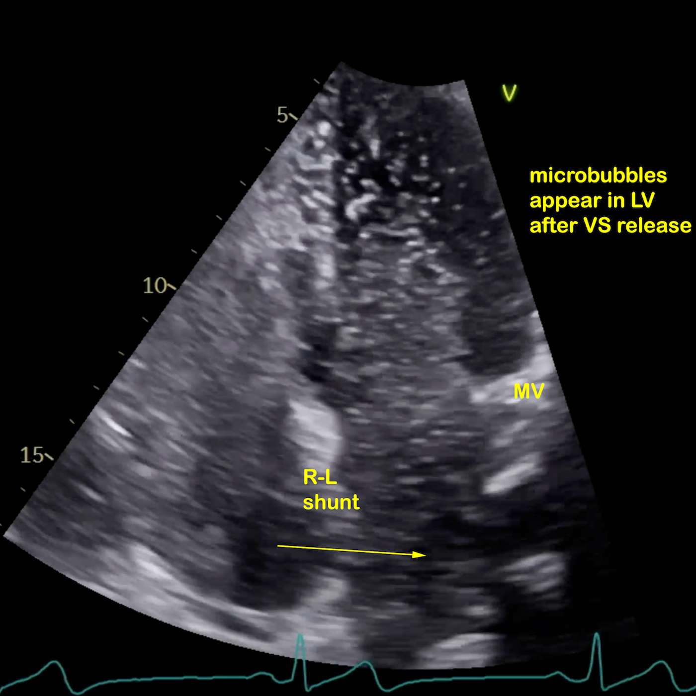 Patent Foramen Ovale (PFO): A Hidden Link in Stroke, TIA, Migraine and More — When to Close the Hole in the Heart