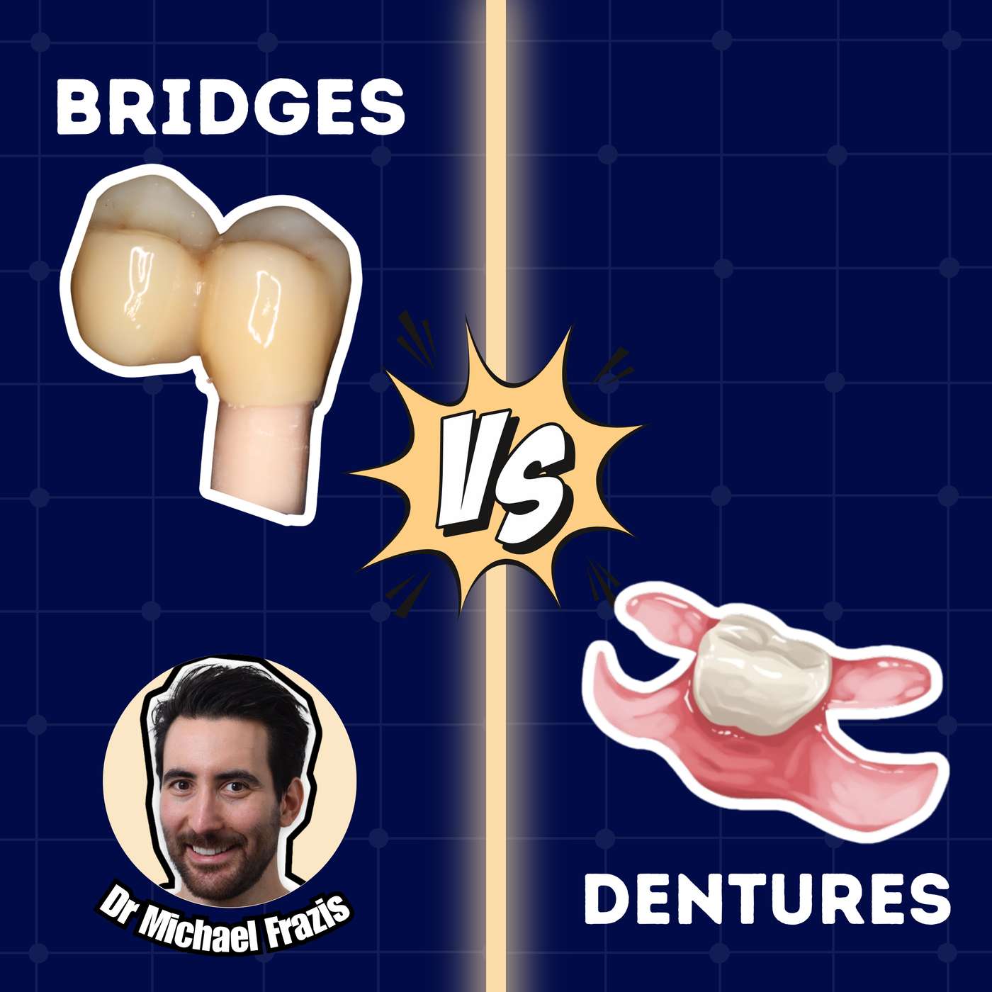 Treatment Planning Bridges vs Dentures – The Art and Science – PDP198 episode artwork