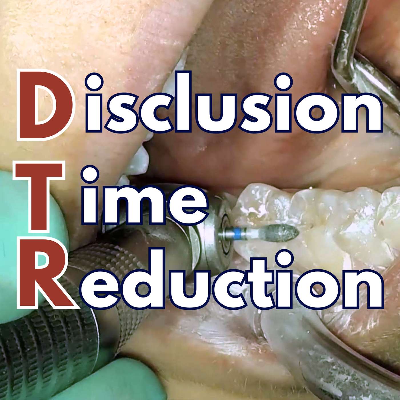 Can Occlusal Adjustment Cure TMD? ‘DTR’ and T Scan Experience – PDP255