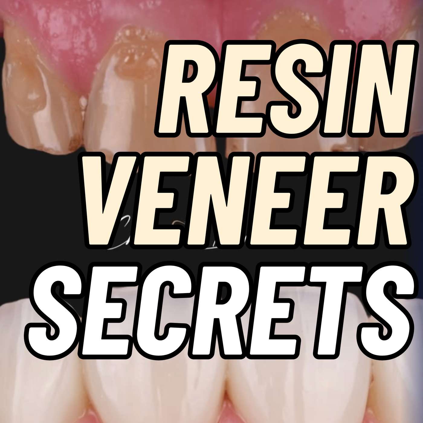 3 Secrets of STUNNING Resin Veneers Revealed! – PDP259