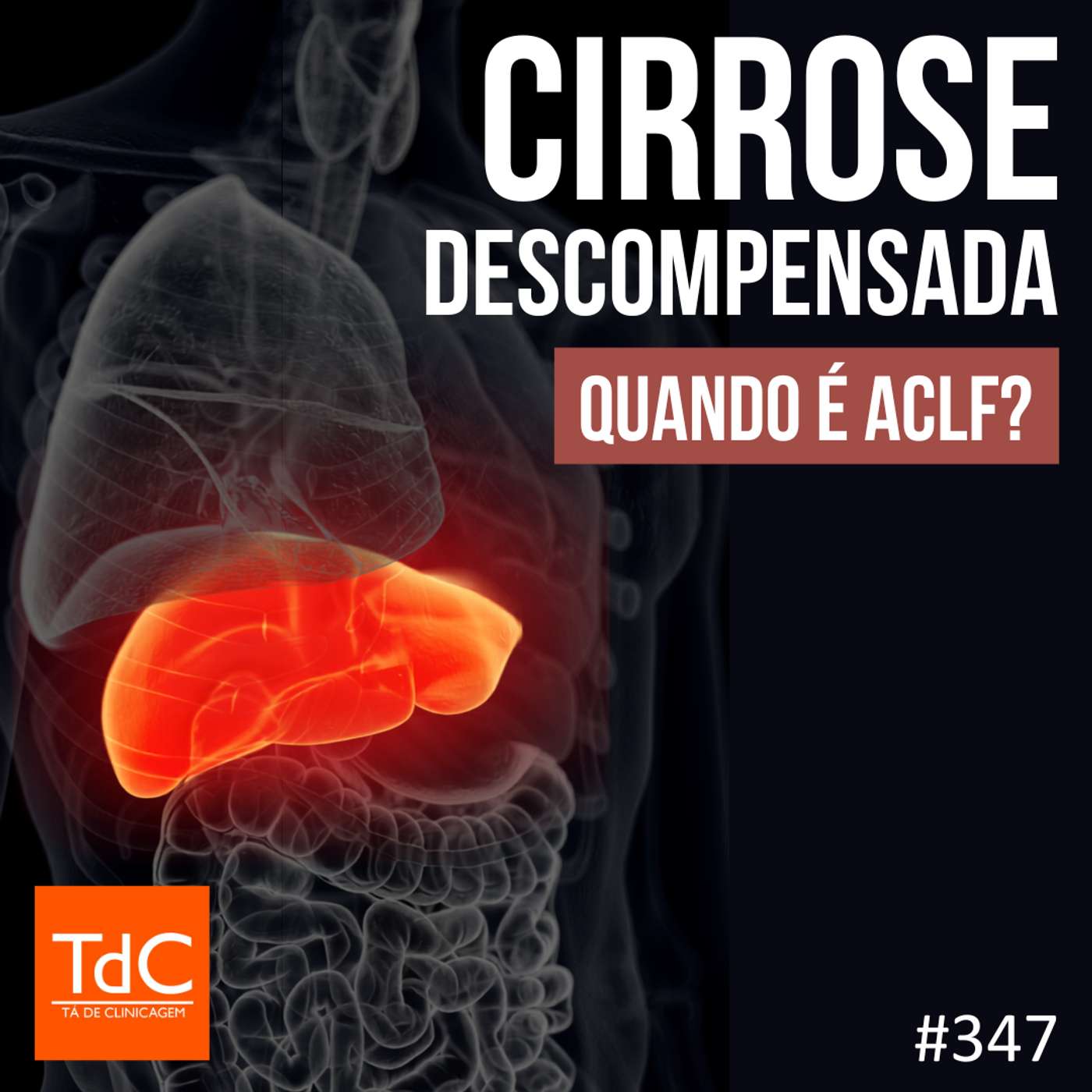 TdC 347: Cirrose descompensada - quando é ACLF?