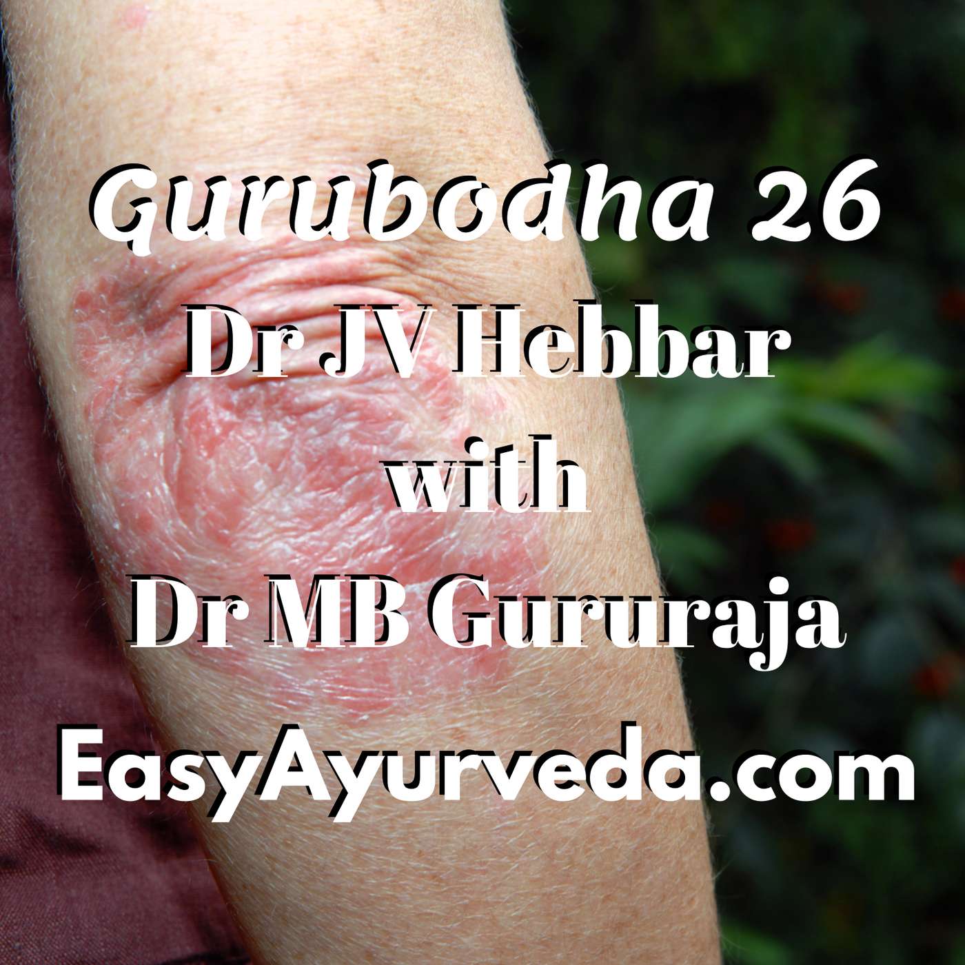 Gurubodha 26: Psoriasis Case Study | Allergic Redness of Eyes | Yashtimadhu Uses episode artwork