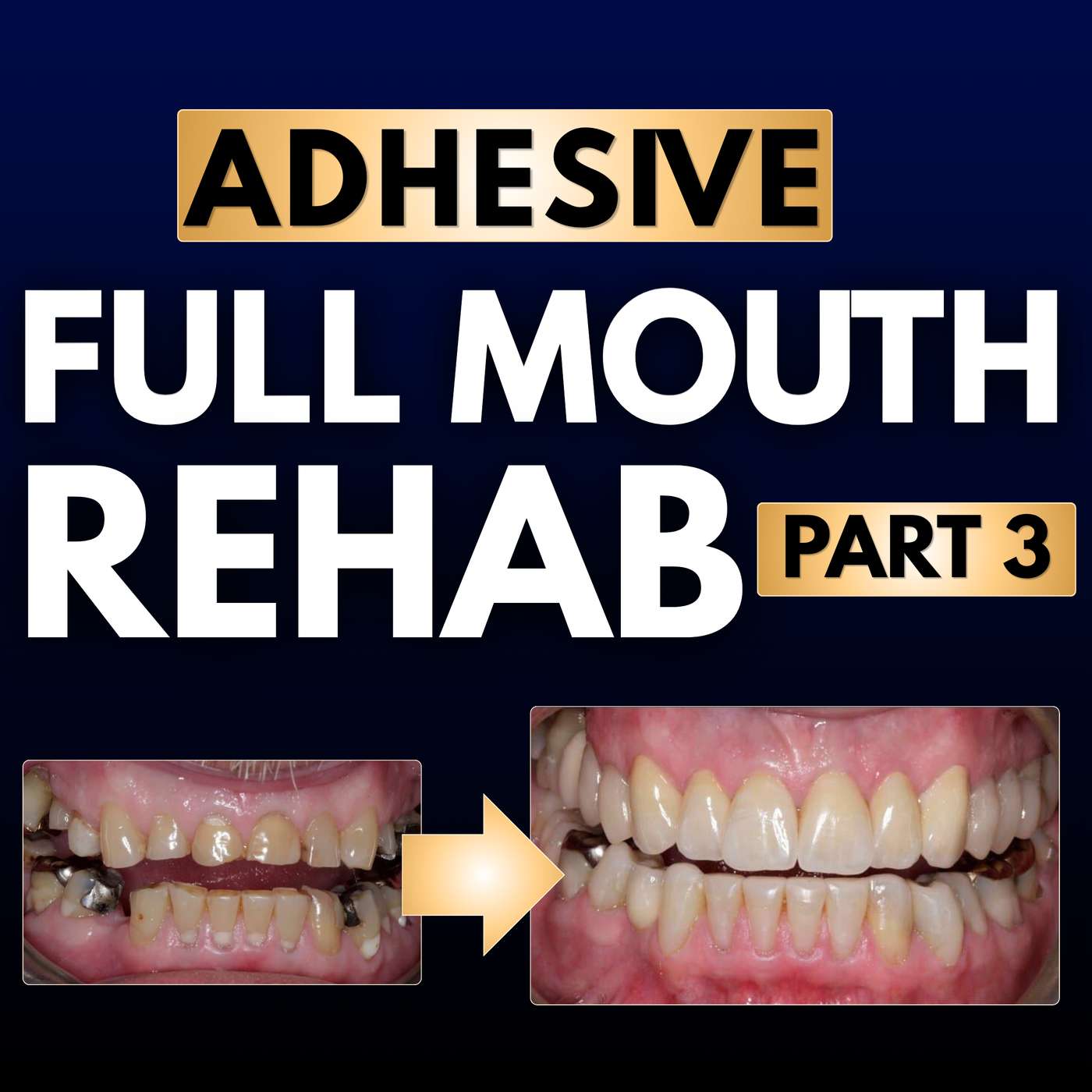 Adhesive Full Mouth Rehabs Part 3 – FULL WORKFLOW! – PDP110 episode artwork