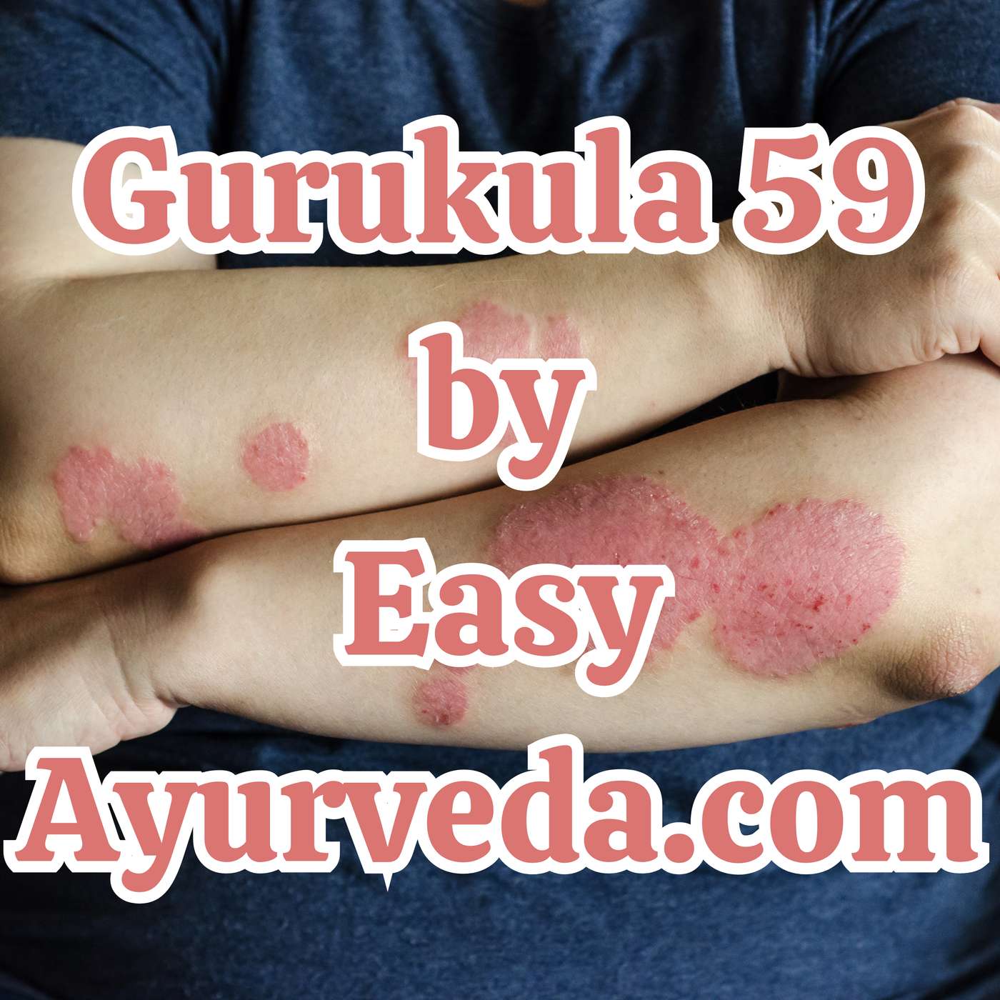 Gurukula 59: ”Healing Psoriasis through Ayurveda” episode artwork