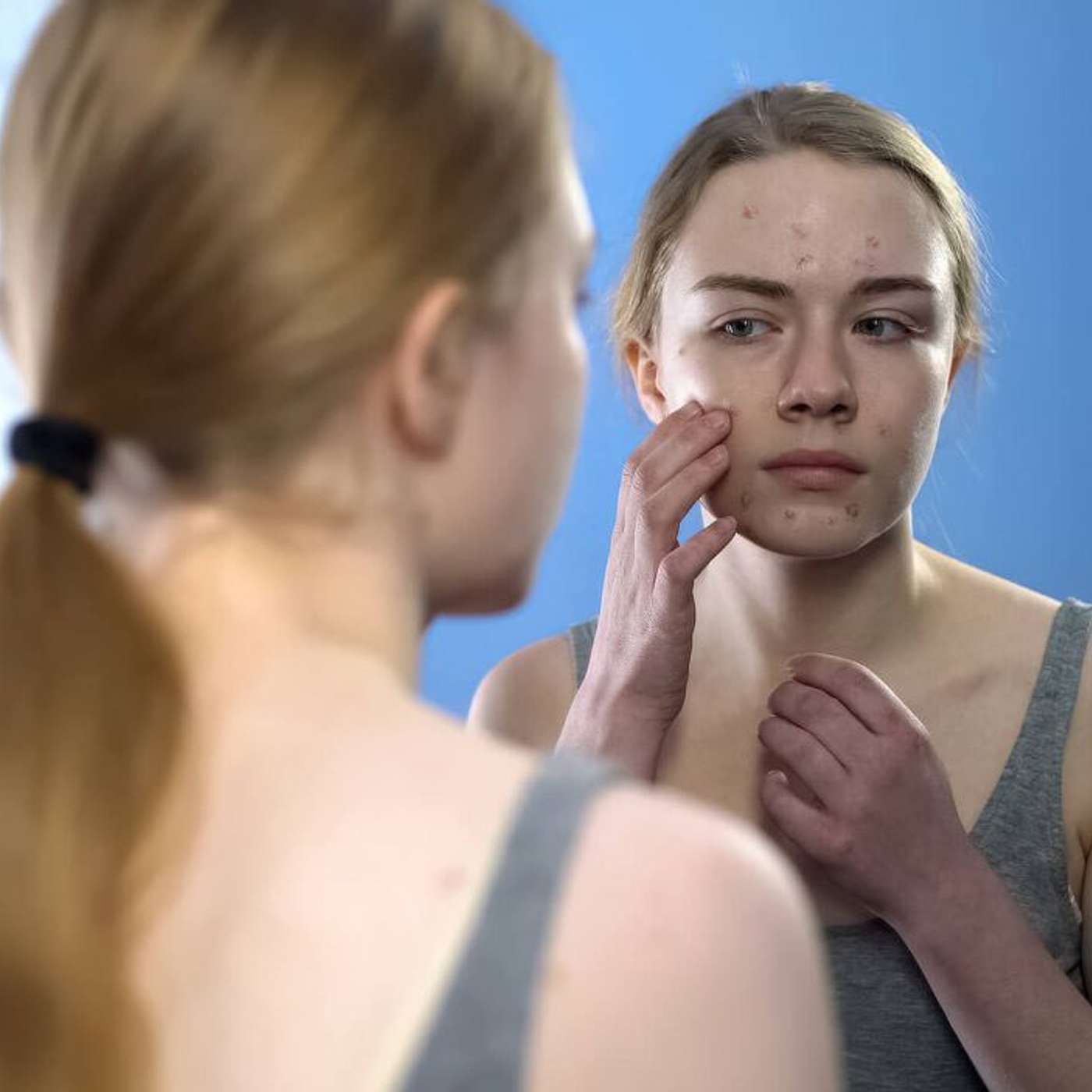 “No quiero que me vean”: el impacto del acné en la salud mental del adolescente episode artwork