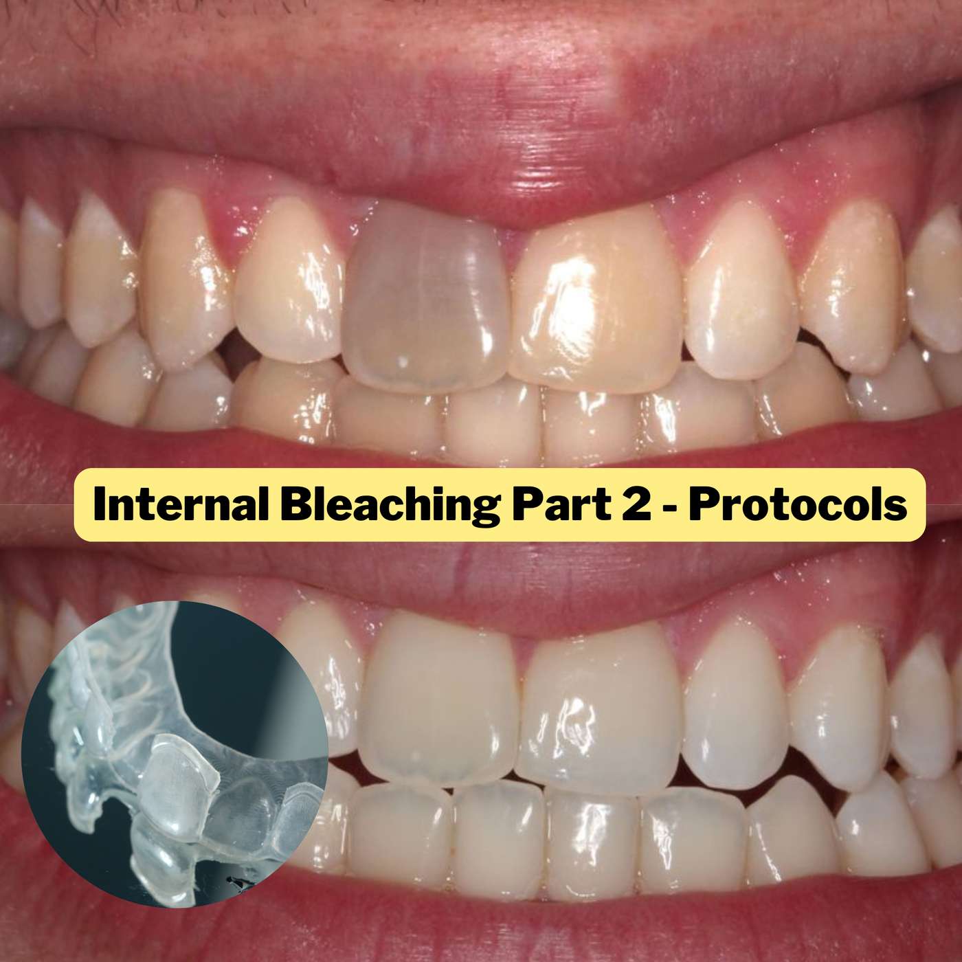 Internal Whitening Protocols Pt2 (Non Vital Bleaching) – PDP147 episode artwork