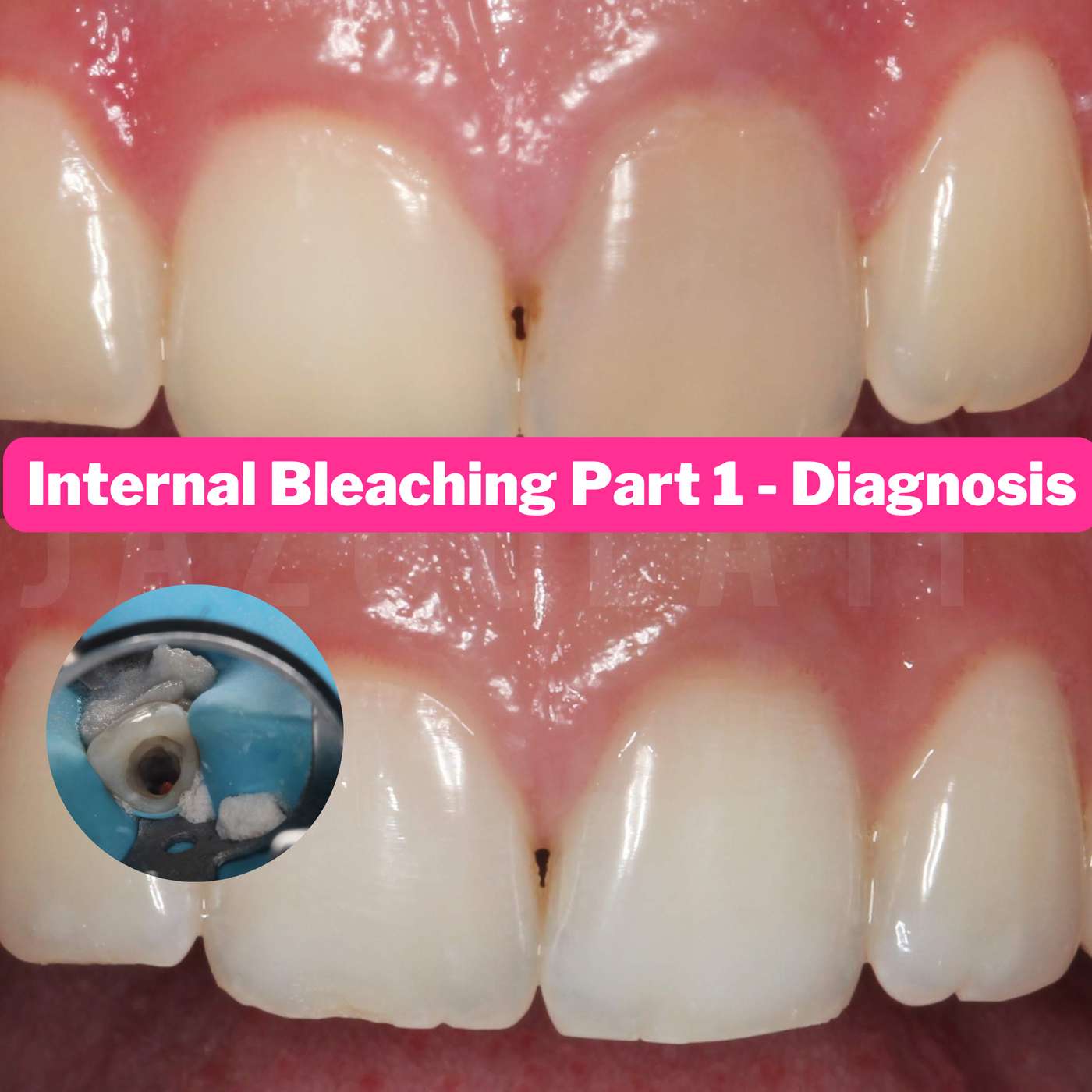 Internal Whitening Protocols Pt1 (Non Vital Bleaching) – PDP146 episode artwork
