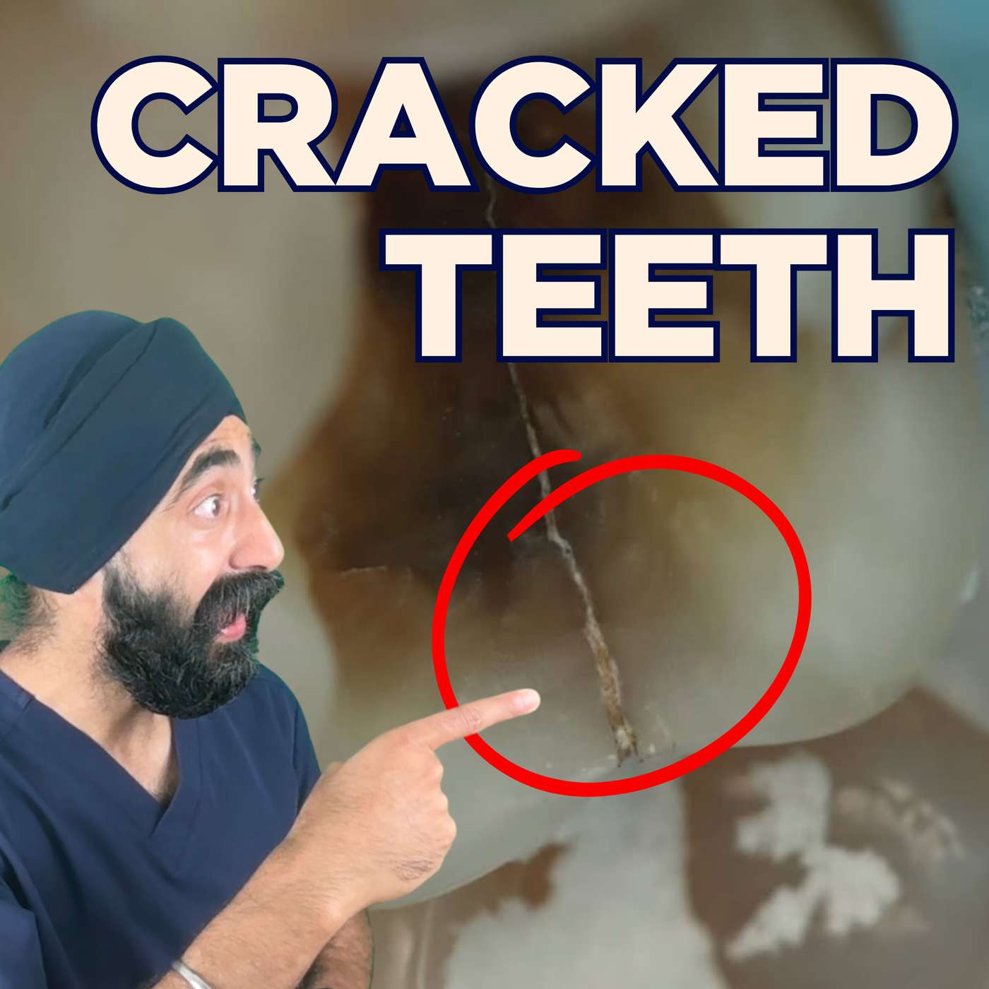 Cracked Teeth Clinical Guidelines – Chase? Fibers? WHEN to Intervene – PDP246