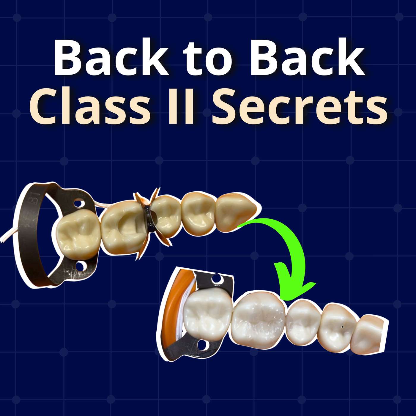 Back to Back Class II Secrets (Sectional Matrix Troubleshooting) – PDP104 episode artwork