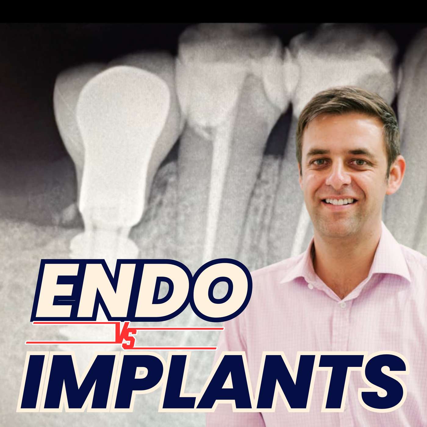 Endodontics vs Implants with Omar Ikram – PDP238