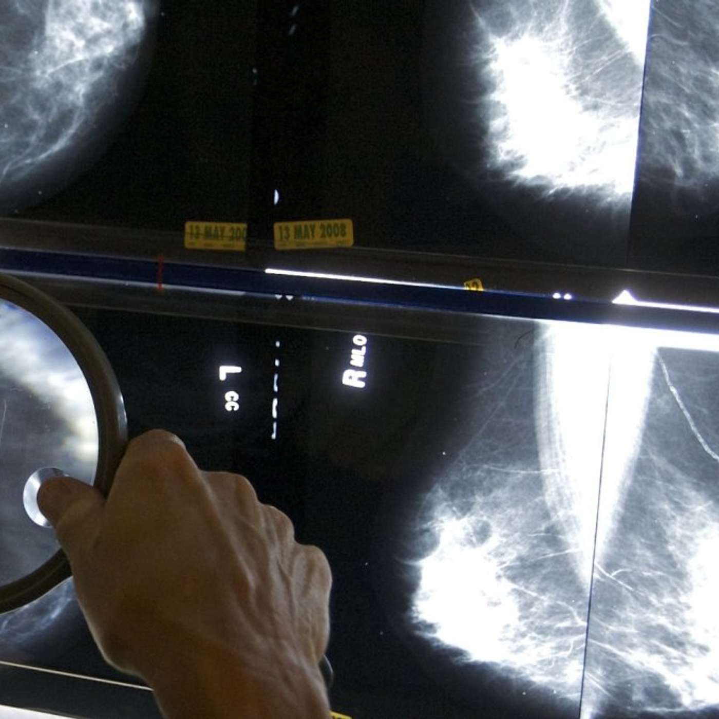 Rising Young Adult Cancer Rates, MaaT Pharma's ALS Therapy Shows Promise, EVE-Vax Transforms Vaccine Design, Exploring New Immunity Research, and more...