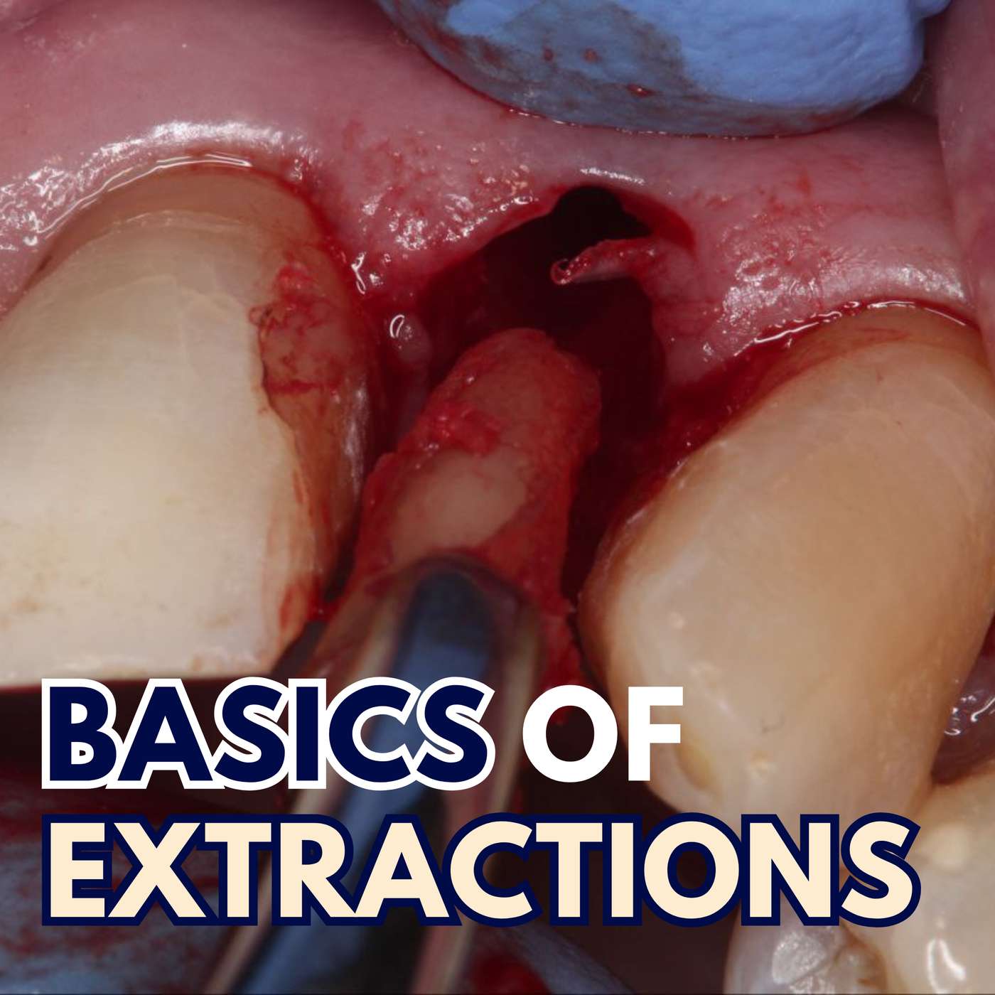 Exodontia for Beginners – Extractions via Avocados! – PS012 episode artwork