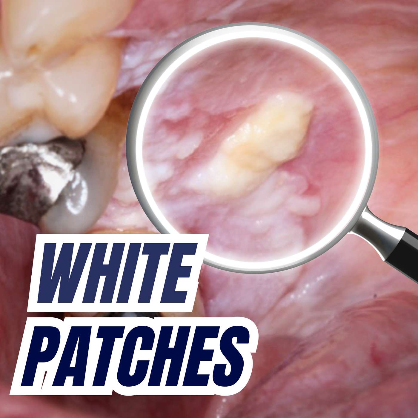 White Patches – When to Refer + Diagnoses ORAL MED – PDP206 episode artwork