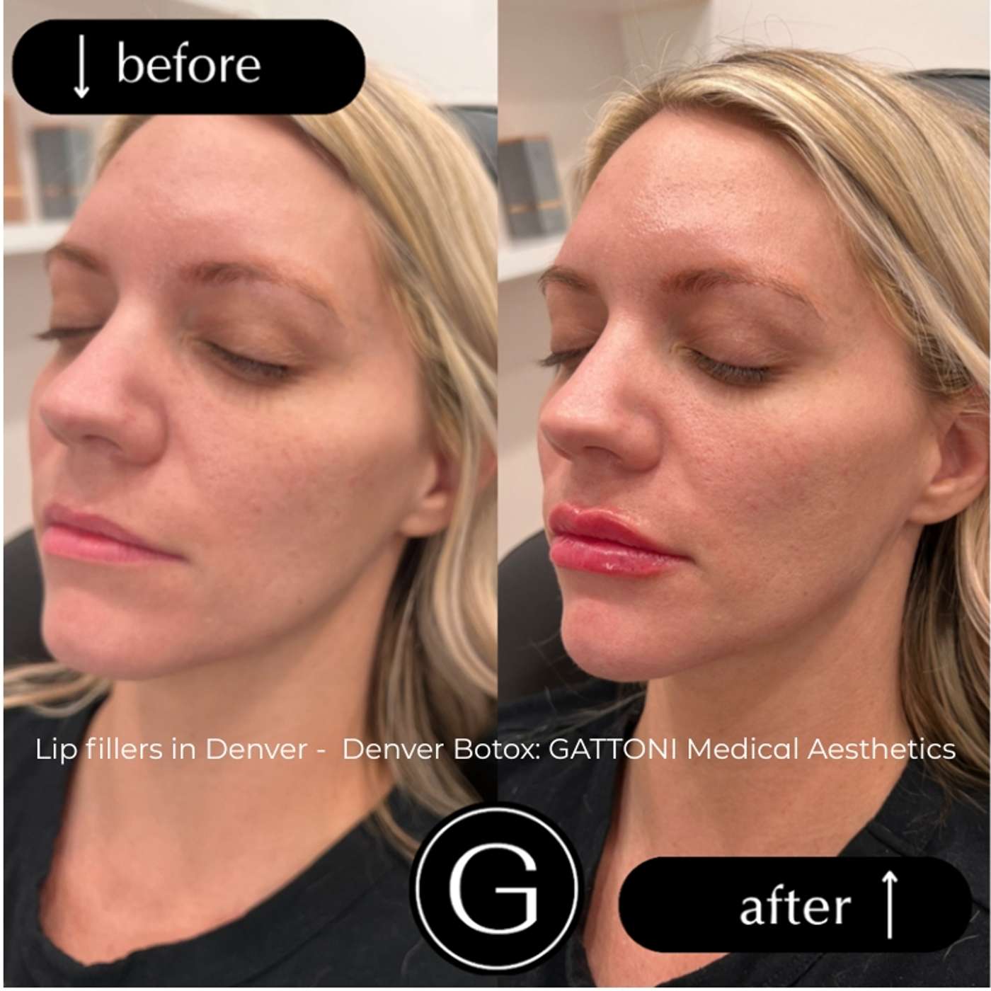 Lip fillers in Denver -  Denver Botox: GATTONI Medical Aesthetics