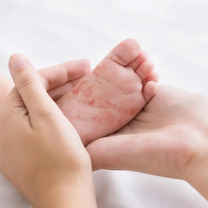 S’inquiéter de la rougeole