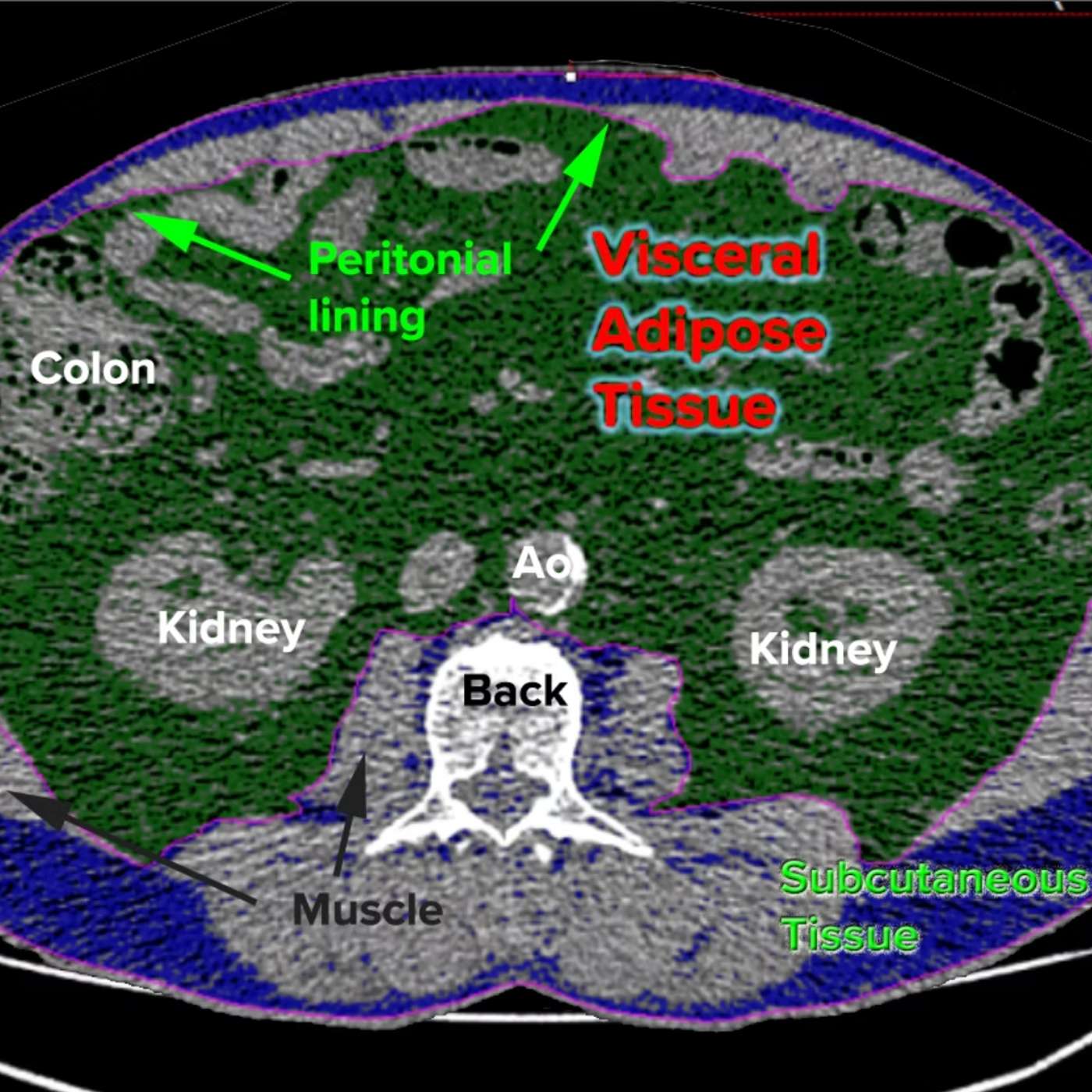 The Hidden Fat That Predicts Heart Disease Better Than Weight episode artwork