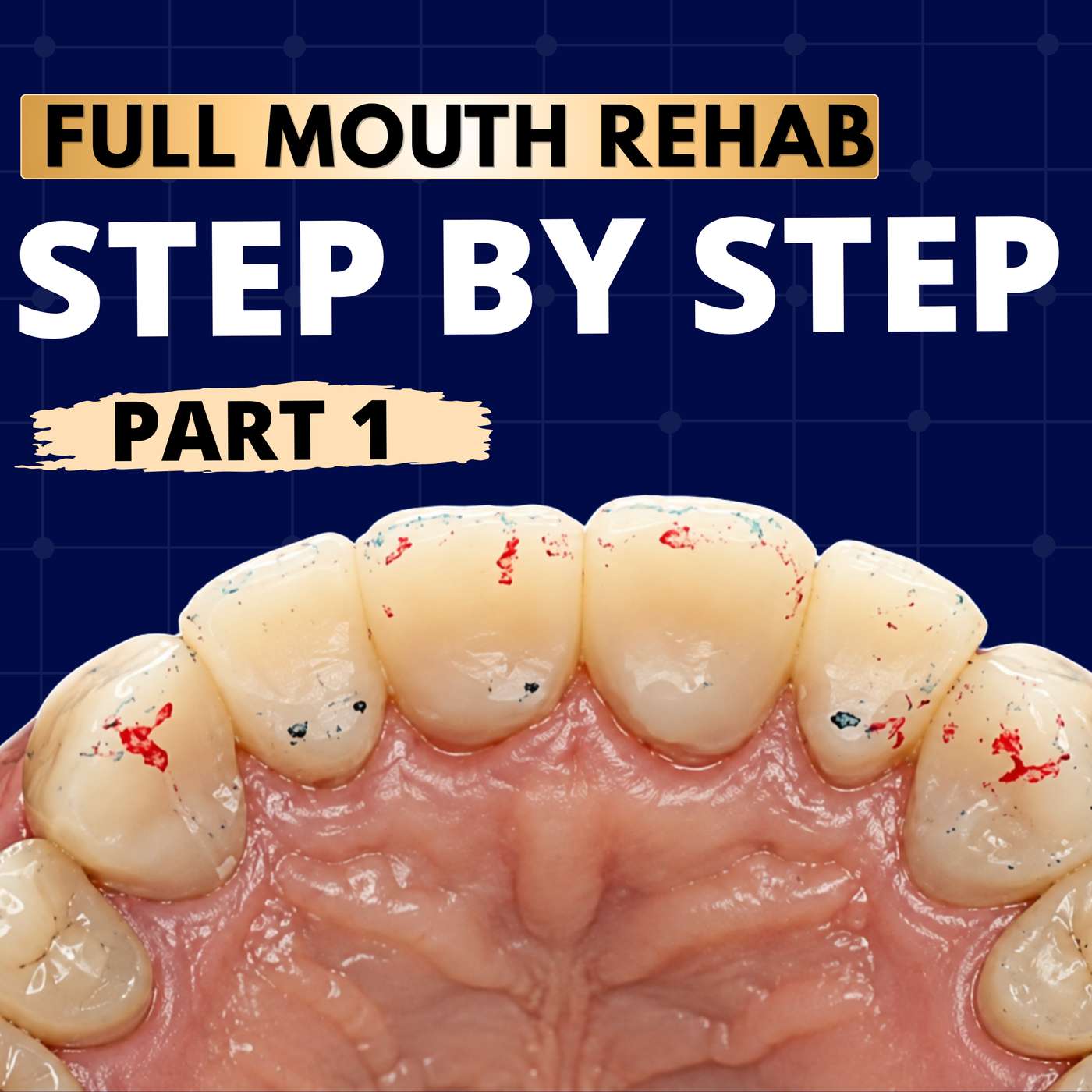 Adhesive Full Mouth Rehabs in 11 Appointments (Part 1) – PDP103 episode artwork