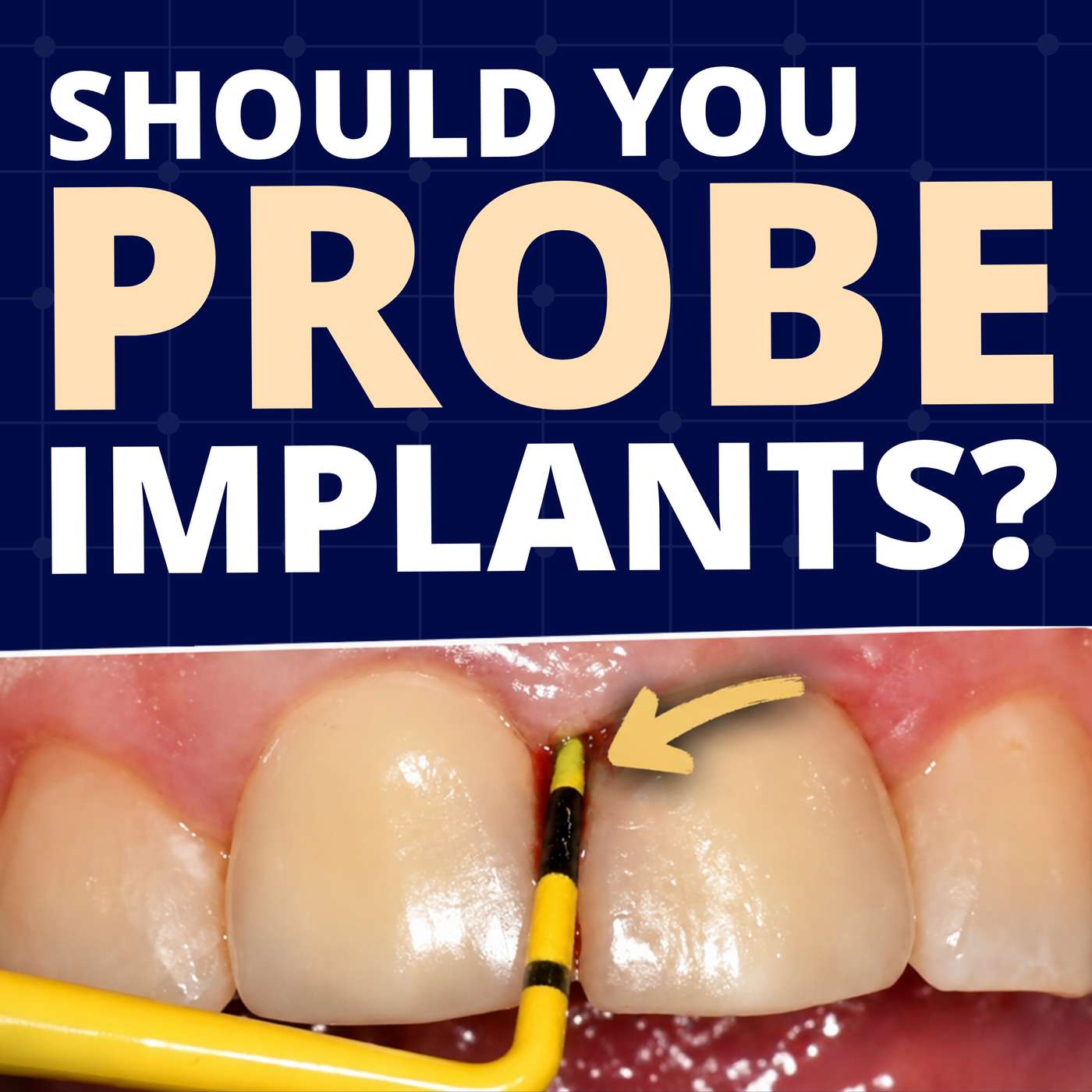 Can I Probe This Implant? – GF013 episode artwork
