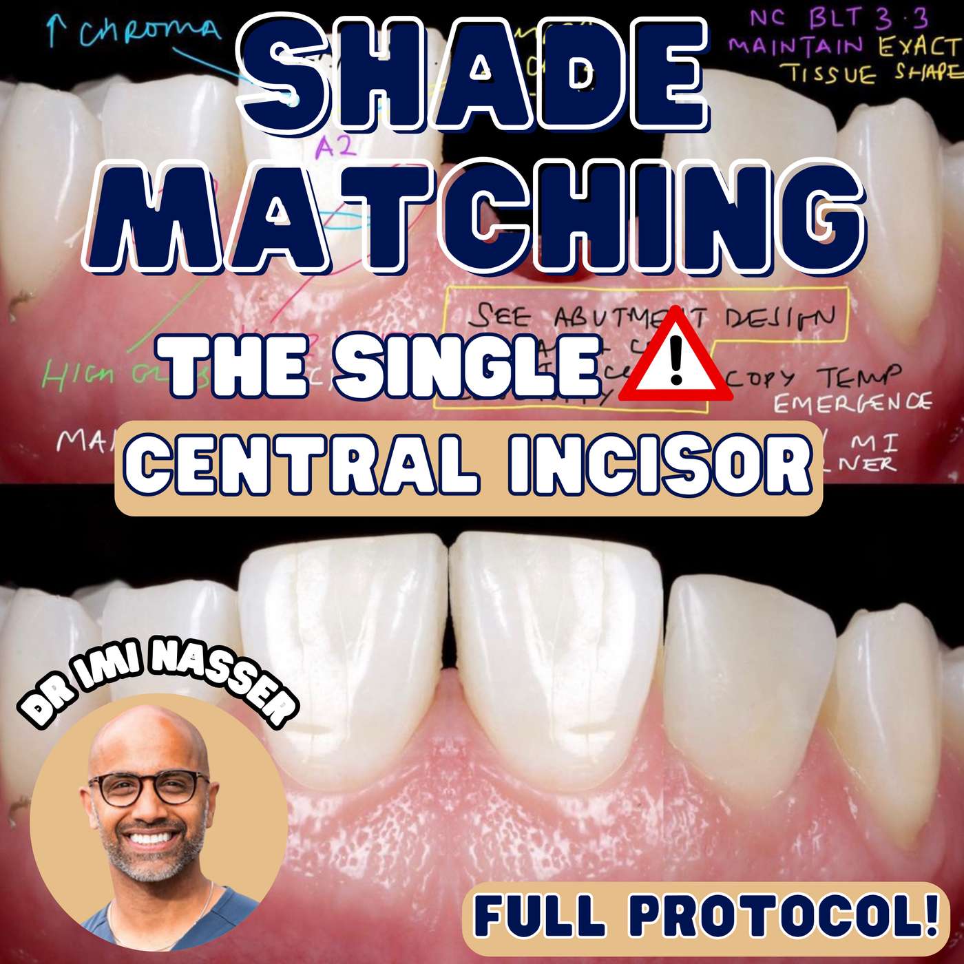 How to Shade Match the Single Central Incisor – PDP165 episode artwork