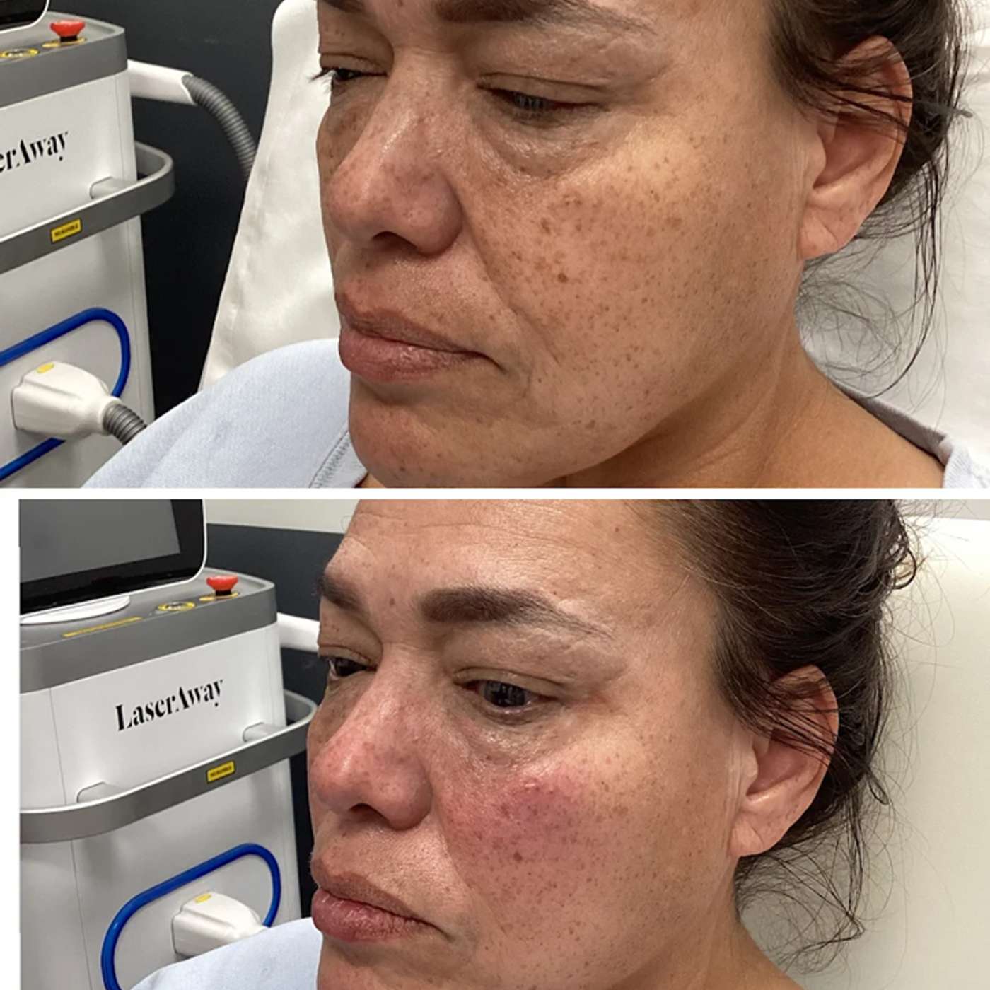 Chemical peel for Denver Botox: GATTONI Medical Aesthetics