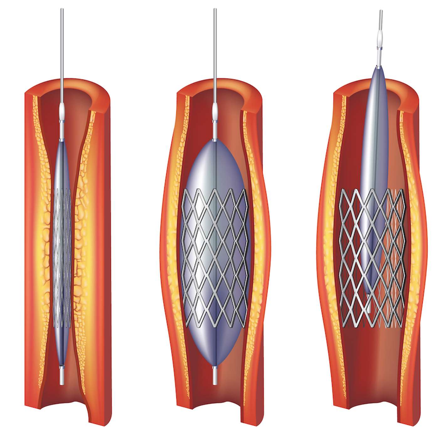 10 Things Everyone Who Has Had a Coronary Stent or Bypass Operation Should Know