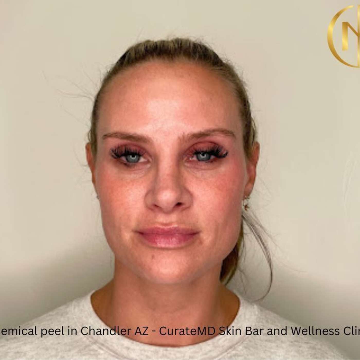 Chemical peel in Chandler AZ - CurateMD Skin Bar and Wellness Clinic episode artwork