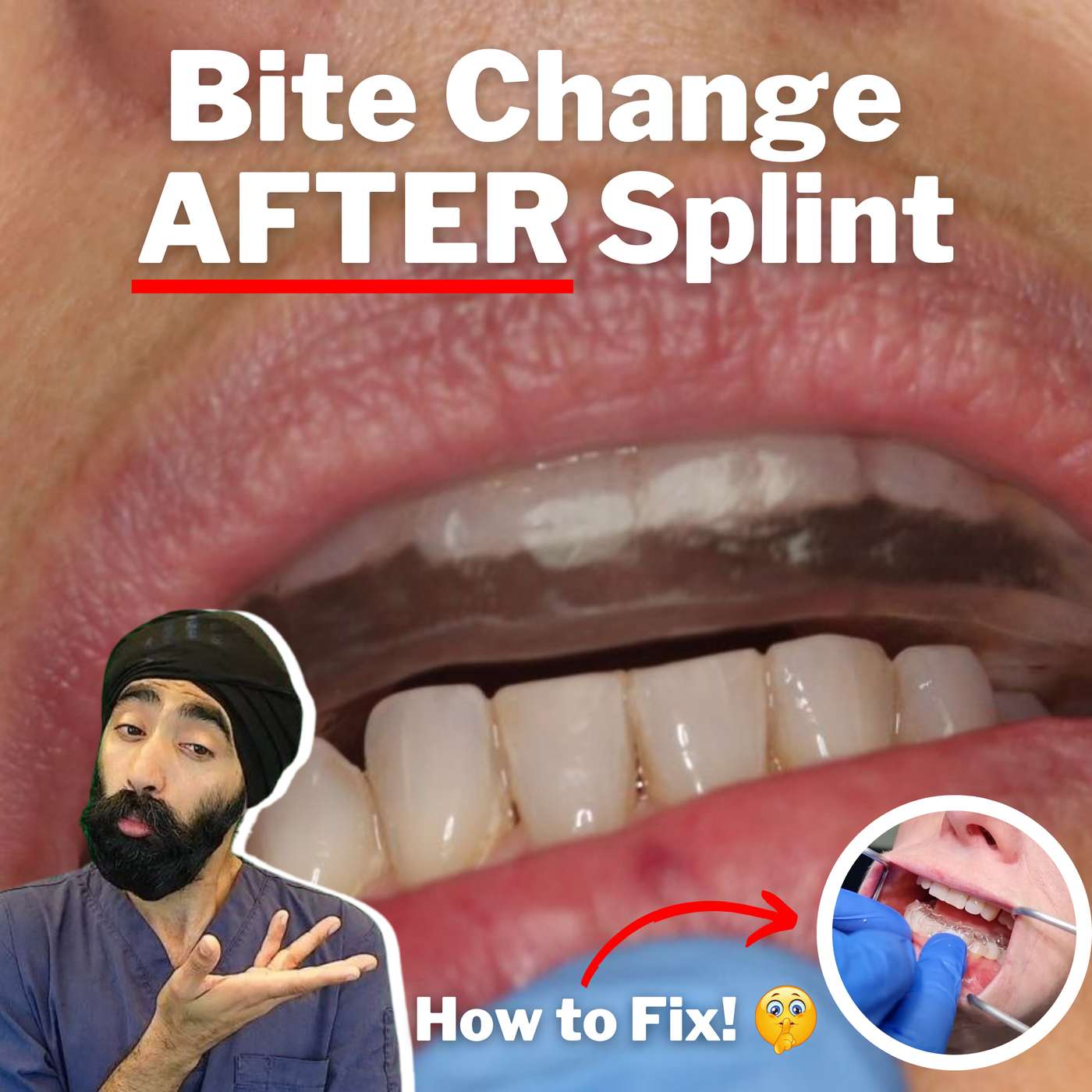 A Little Trick to Solve Anterior Open Bites after Occlusal Appliances – AJ003 episode artwork