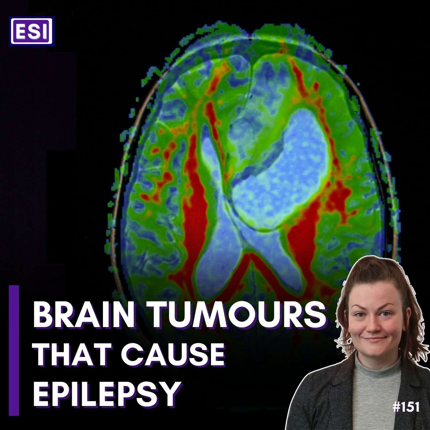 Epilepsy Caused by Brain Tumours - Kate Connor episode artwork