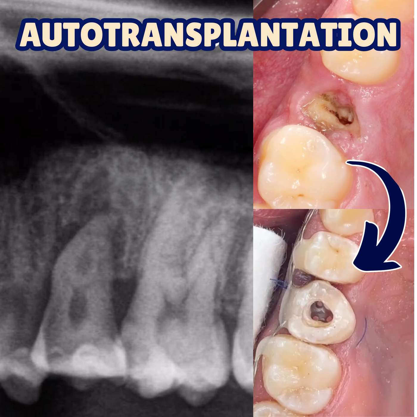Replacing Premolars with Wisdom Teeth – Autotransplantation by a GDP! – PDP193 episode artwork
