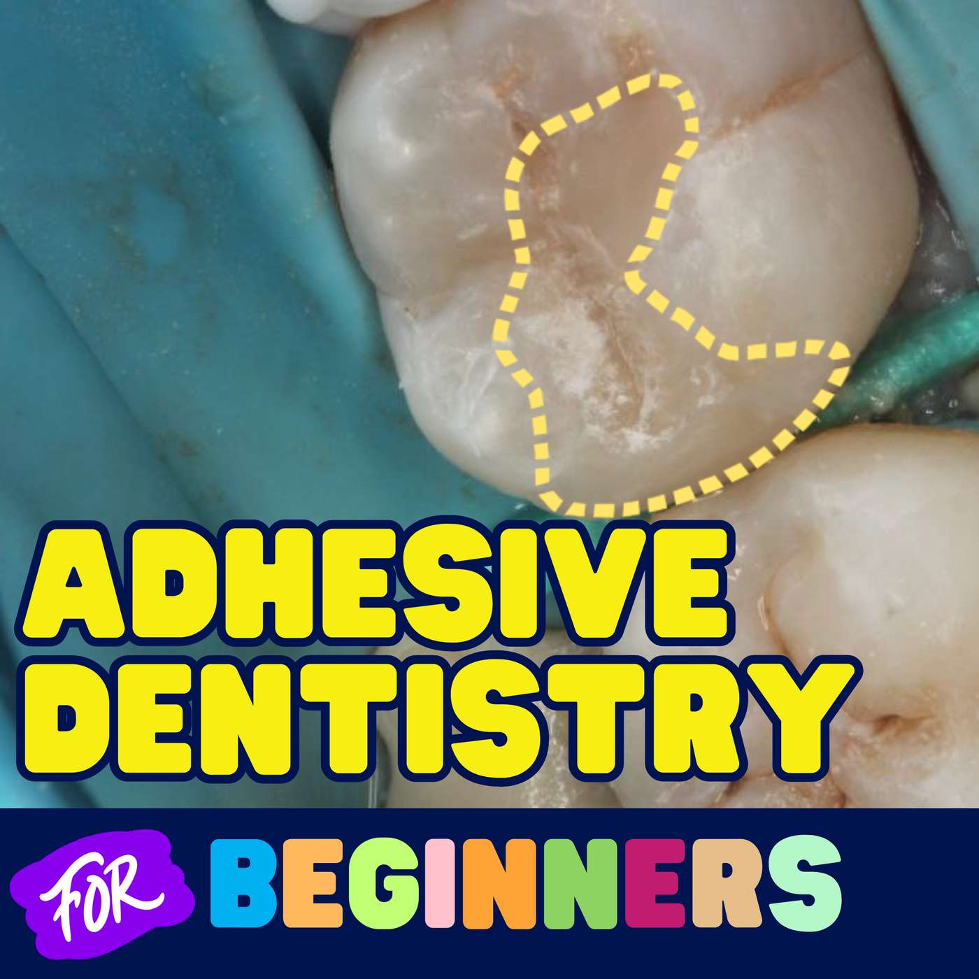 Adhesive Dentistry for Beginners – PS002 episode artwork