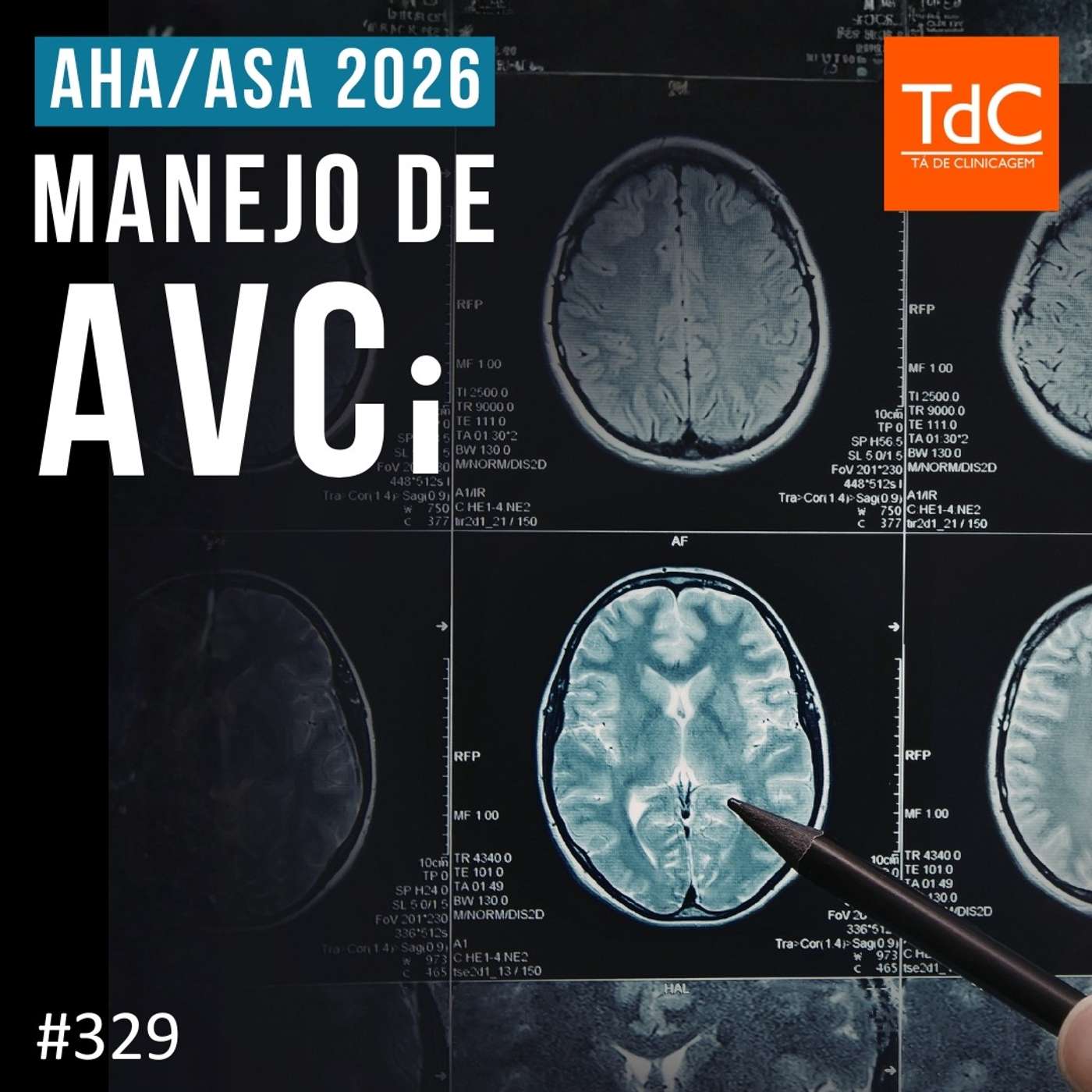 TdC 329: Manejo de AVC isquêmico - Guideline AHA/ASA 2026