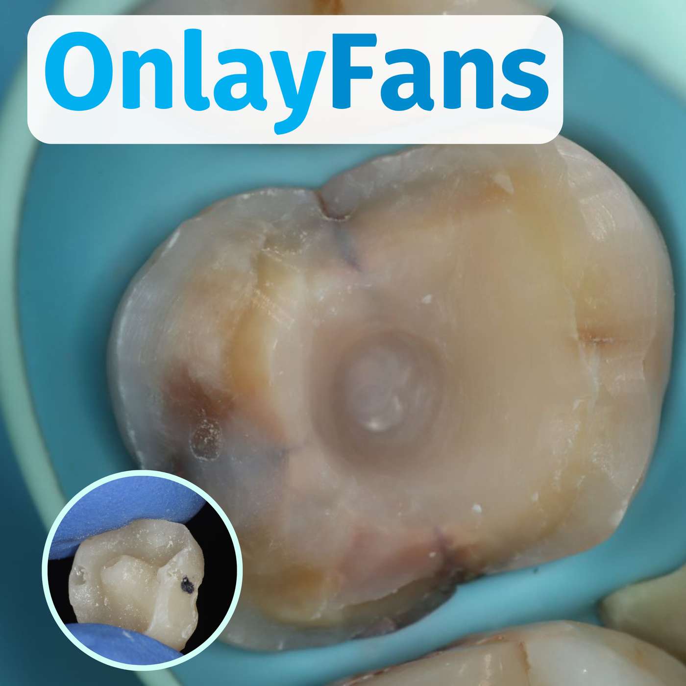 A Geeky Discussion on Adhesive Onlays – PDP161 episode artwork